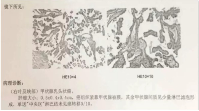 別慌，甲狀腺疾病還可以這樣投保！