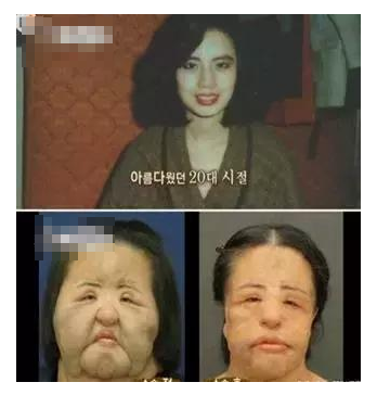 整容發(fā)生意外保險(xiǎn)賠嗎？